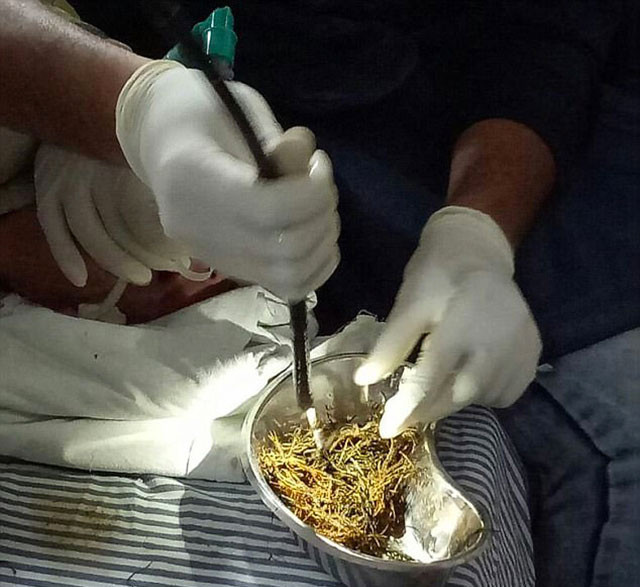 Karın ağrısı nedeniyle hastaneye kaldırıldı içinden bakın ne çıktı - Resim: 3