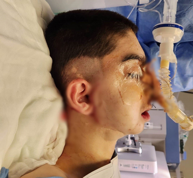 Doğuştan alt çenesi olmayan çocuğa başarılı operasyon: 17 yıl sonra normal yemek yiyebilecek - Resim: 2