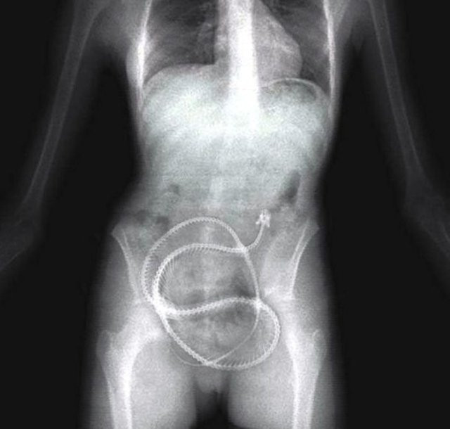 Midesinden öyle şeyler çıktı ki... - Resim: 1