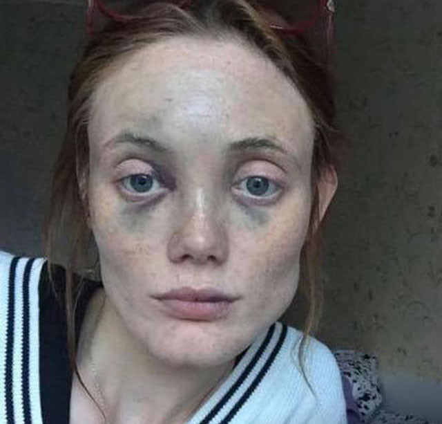 Ünlü manken tanınmaz halde! Baygınken tecavüz etmeye kalkışmış - Resim: 3