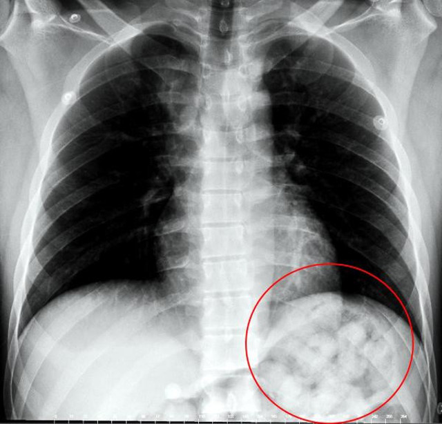 Ankara'da ilginç olay! Rahatsızlanan İranlı yolcunun midesinden 890 gram uyuşturucu çıktı - Resim: 1
