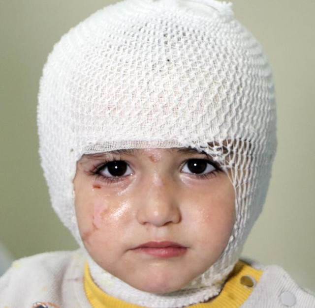 Başından aşağı kaynar çay dökülen minik Hüyesin yandı - Resim: 1