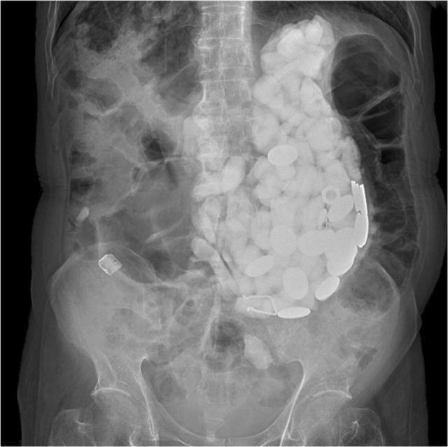 Midesinden çıkanı duyunca şoke olacaksınız! Tam 2 kilo - Resim: 2