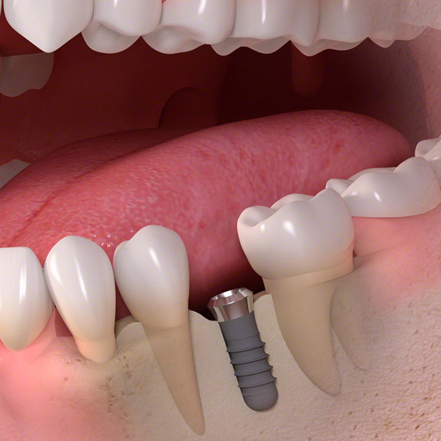 Uzman uyardı! Diş sağlığında kemik kaybı oluşmadan implant yapılmalı - Resim: 0