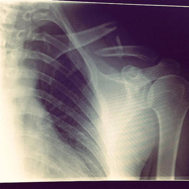 Vücudundan çıkarılan platinle öyle bir şey yaptı ki... - Resim: 1