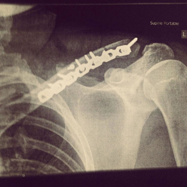 Vücudundan çıkarılan platinle öyle bir şey yaptı ki... - Resim: 2