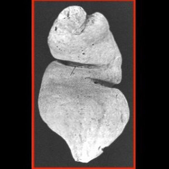 Akıllara durgunluk veren olay anüsünden topçu mermisi çıktı! - Resim: 4