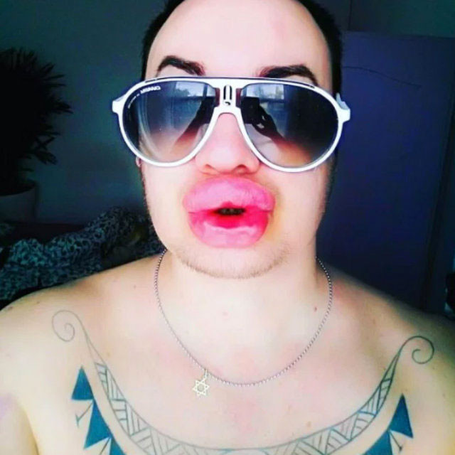 Dudak dolgusu faciası 27 bin lira verdi sonucu şoke etti - Resim: 3