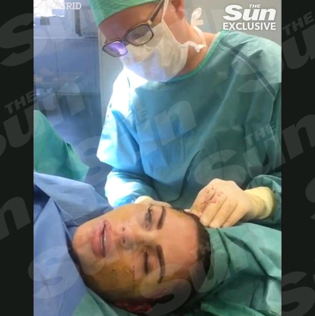 Katie Price yüz germe ameliyatını yayınladı! - Resim: 4