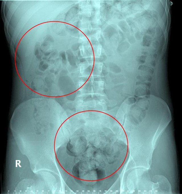 Ankara'da ilginç olay! Rahatsızlanan İranlı yolcunun midesinden 890 gram uyuşturucu çıktı - Resim: 0