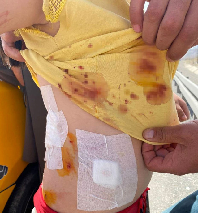 Sivas'ta 9 yaşındaki kız çocuğuna 7 köpek birden saldırdı - Resim: 0