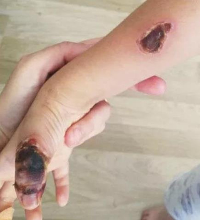 İstanbul'da MR çektikleri 7 yaşındaki Elif'i yaktılar! - Resim: 1