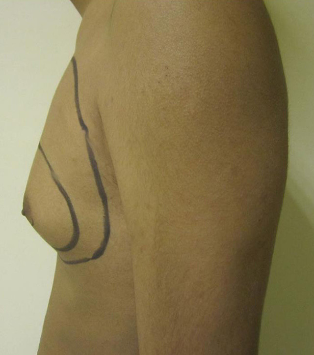 Meme küçültme Karadeniz'de en çok yapılan ikinci ameliyat! - Resim: 3