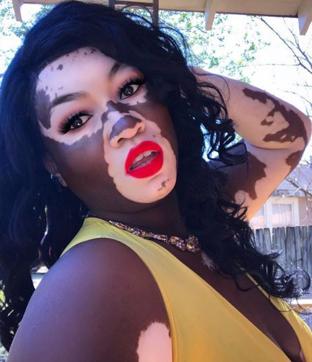 Vitiligolu model isyan etti! 'Ne yani böyleyim diye ölmem mi gerekiyor?' - Resim: 4