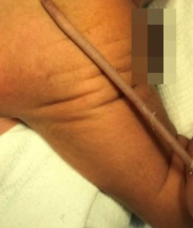 Brezilya’da bir bebek 12 santimetre kuyrukla doğdu! - Resim: 0