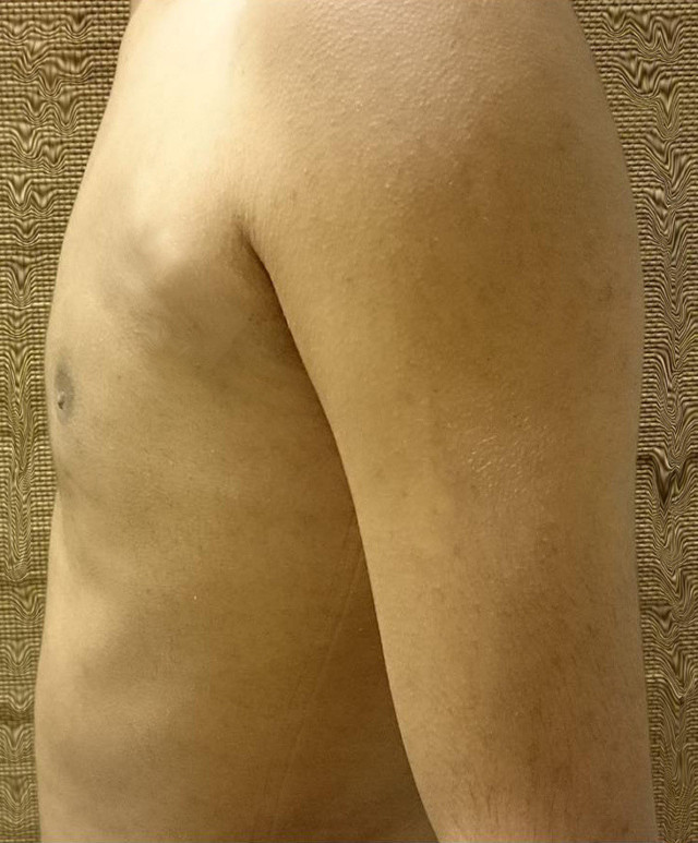 Meme küçültme Karadeniz'de en çok yapılan ikinci ameliyat! - Resim: 4