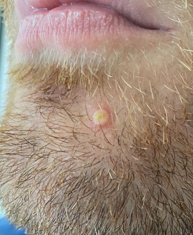 Türkiye’de de görülen maymun çiçeği hastalığına yakalanan kişi konuştu! Semptomlarına bakın - Resim: 1