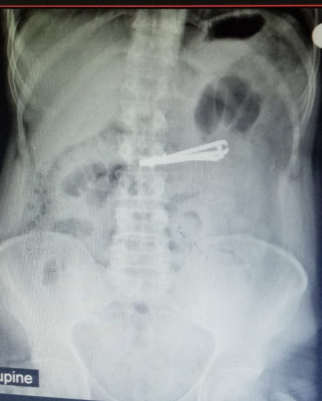 Siirt'te tırnak makasını yutan bir kişi ameliyatla sağlığına kavuştu - Resim: 0