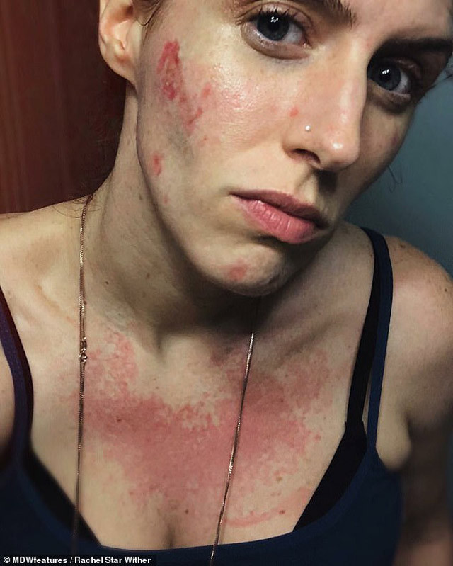 Önce göğsünde çıktı sonra yüzünü yemeye başladı! - Resim: 1