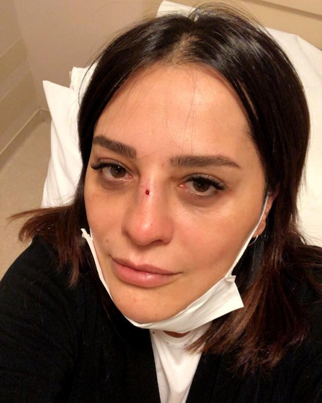 Ünlü şarkıcı Reyhan Karaca’nın burnu kırıldı - Resim: 3