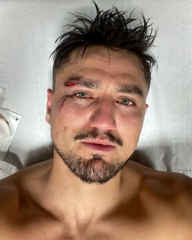 Cengiz Ünder yürekleri ağza getirdi! Maç sonu paylaştı, yüzü bu hale geldi - Resim: 1