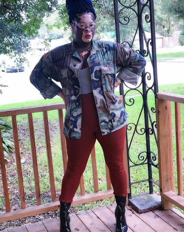 Vitiligolu model isyan etti! 'Ne yani böyleyim diye ölmem mi gerekiyor?' - Resim: 3