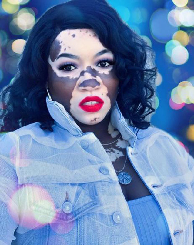 Vitiligolu model isyan etti! 'Ne yani böyleyim diye ölmem mi gerekiyor?' - Resim: 2