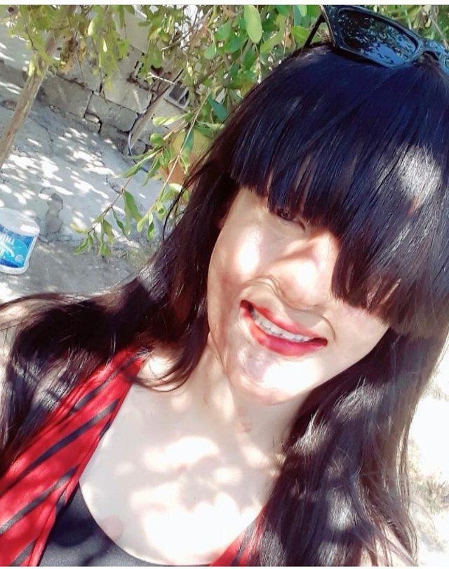 Yüzünü asitle yakan sevgilisini affeden Berfin Özek: Bunu nasıl yapabildim - Resim: 1