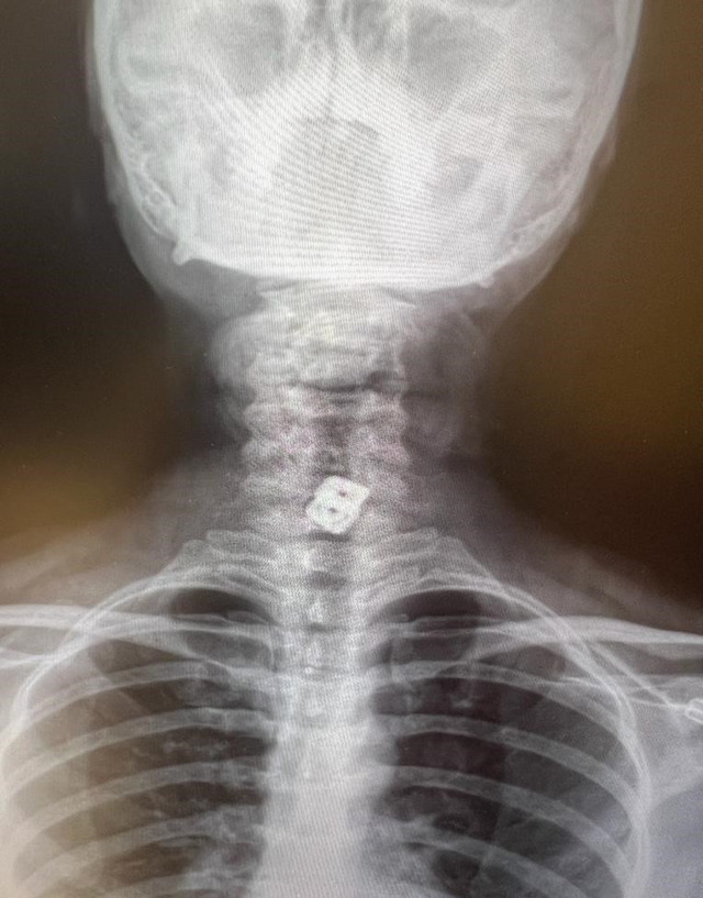 Tıp literatüründe ender görülen olay! Ameliyattan günler sonra oldu: Yemek borusunu delerek mideye düştü - Resim: 0