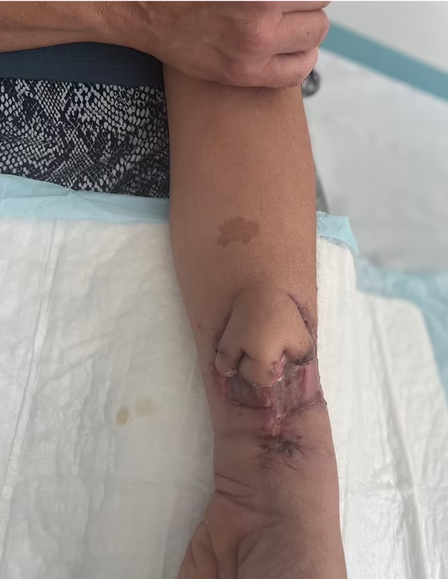 Burnu kolunda yeniden çıktı! Tıp dünyasında çığır açan buluş - Resim: 1