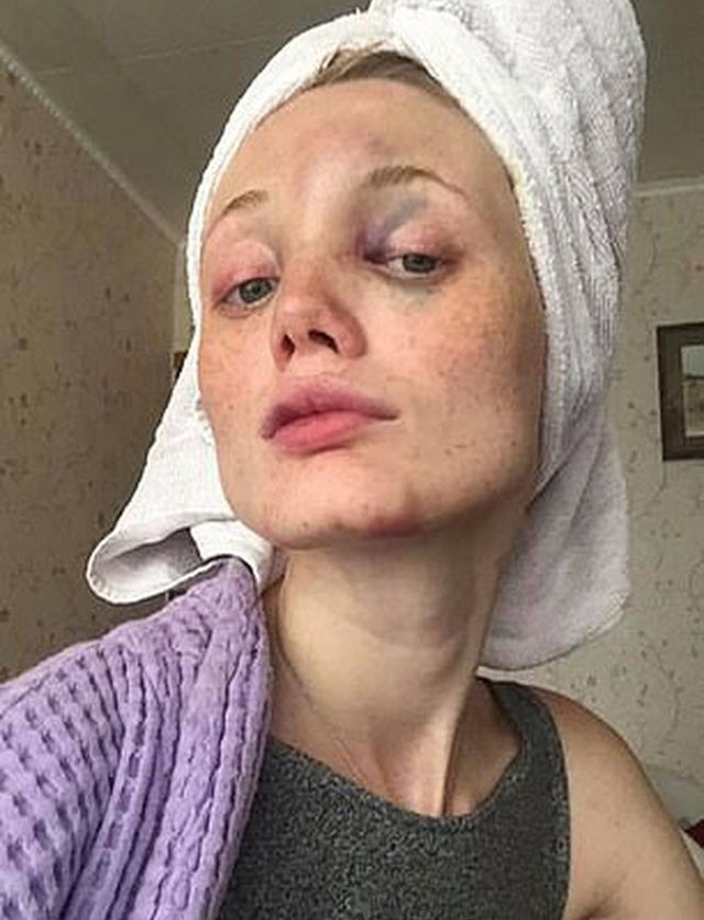 Ünlü manken tanınmaz halde! Baygınken tecavüz etmeye kalkışmış - Resim: 4