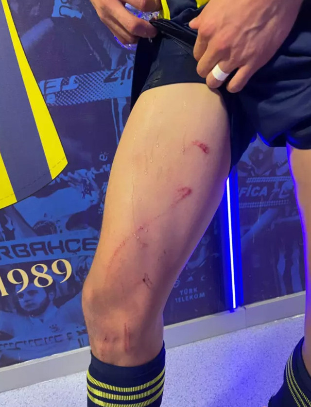 Stuttgart maçında tekme yemişti! Fenerbahçeli yıldızın son hali inanılmaz - Resim: 0