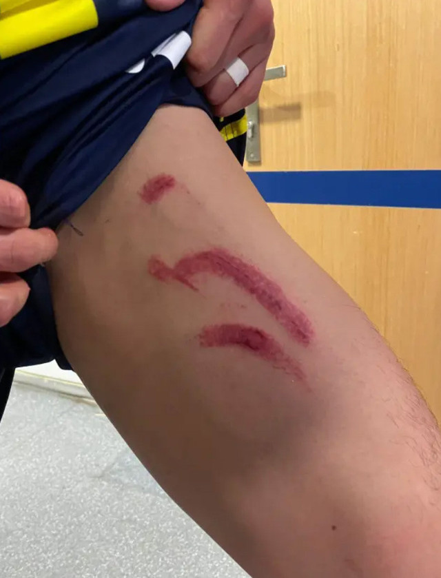 Stuttgart maçında tekme yemişti! Fenerbahçeli yıldızın son hali inanılmaz - Resim: 1