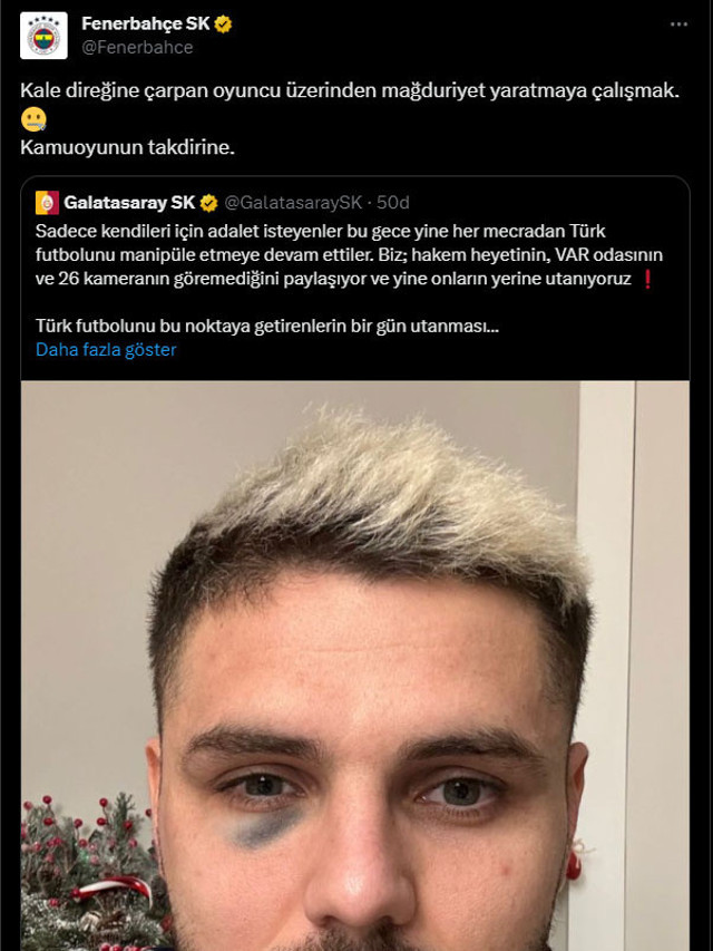 Derbi sonrası Fenerbahçe ile Galasataray Icardi için kapıştı! Dirsek mi morarttı direğe çarptığı için mi morardı - Resim: 2