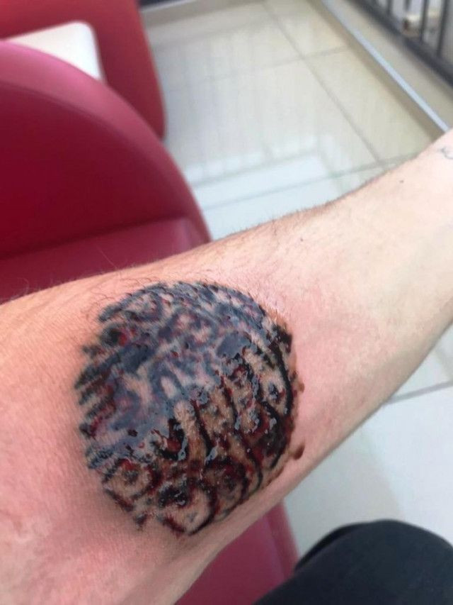 Bodrum'da asker olmak için dövmelerini sildiren genç hayatının şokunu yaşadı - Resim: 3