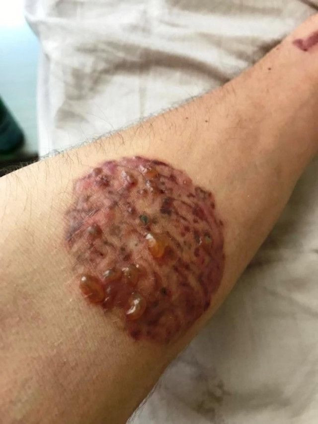 Bodrum'da asker olmak için dövmelerini sildiren genç hayatının şokunu yaşadı - Resim: 4