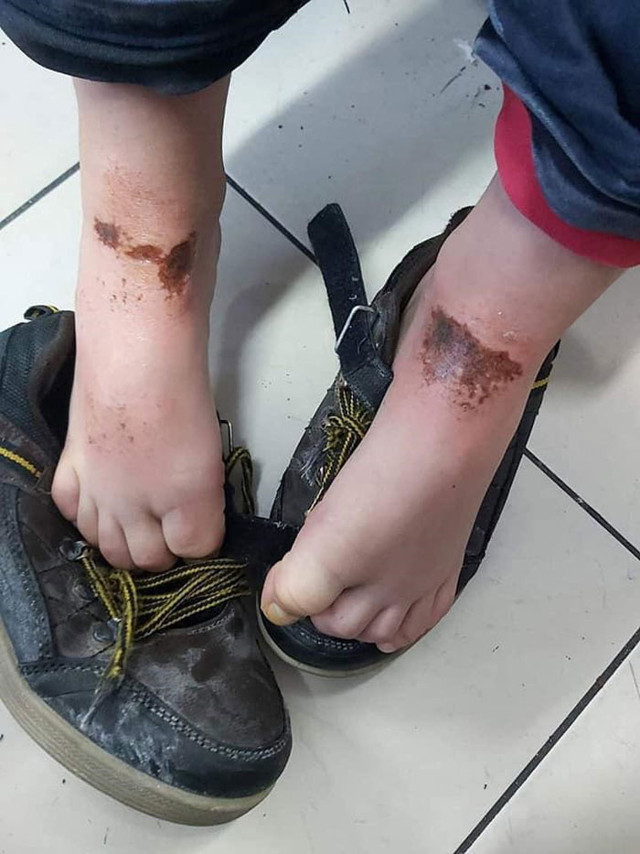 Afyonkarahisar'da okul bahçesinde kar topu oynayan öğrencilerin vücutlarında yanıklar oluştu - Resim: 1