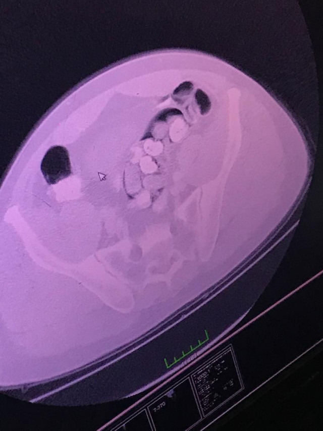 İranlının midesinden çıkan uyuşturucular şaşkınlık yarattı ne ararsan var - Resim: 0