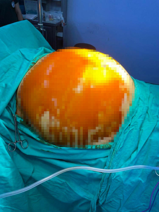 Karın ağrısı şikayetiyle gitti Aydın'da kadının karnından çıkardılar! Ender rastlanan vaka - Resim: 0