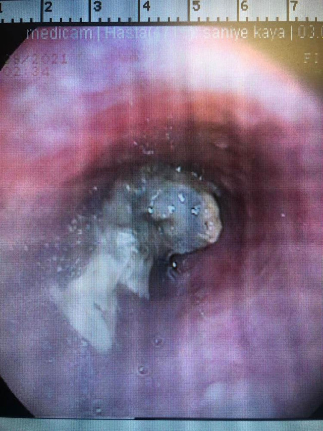 Çanakkale'de şikayet üzerine doktora gitti yemek borusundan çıkardılar - Resim: 0