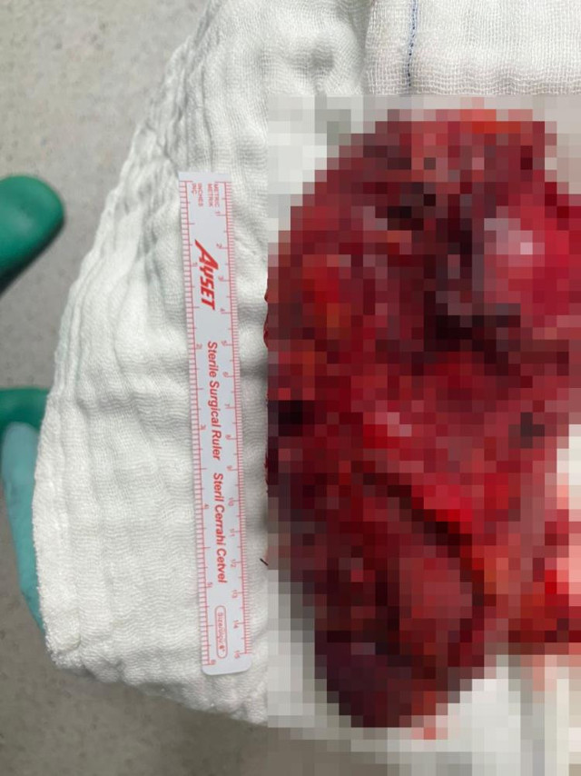 Böbreğinden çıkan şoke etti! 2 buçuk kilo ağırlığında: 1 ay içinde ölebilirdi - Resim: 0