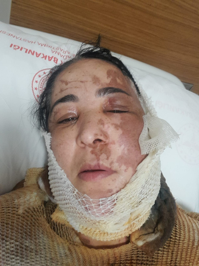 Adana’da üvey evlat vahşeti! 'Başkasıyla evlenemesin' diye yüzüne kezzap attı - Resim: 0