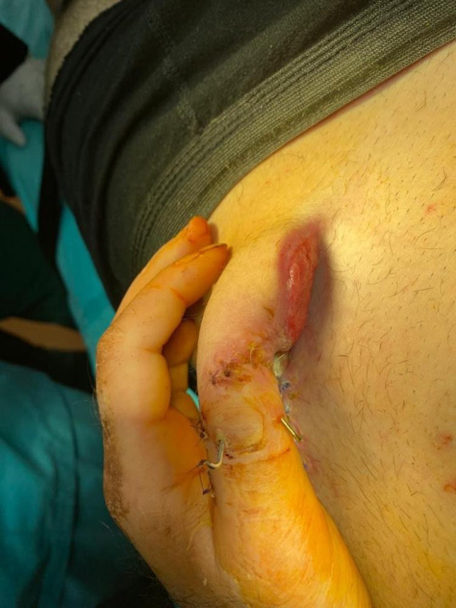 Kazada yarısını kaybetmişti: Kopan parmağını göbeğine dikerek kurtardılar! - Resim: 2