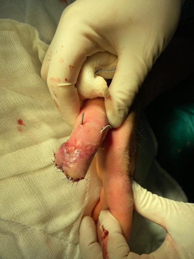 Kazada yarısını kaybetmişti: Kopan parmağını göbeğine dikerek kurtardılar! - Resim: 3