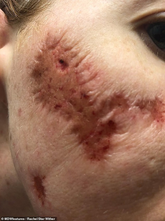 Önce göğsünde çıktı sonra yüzünü yemeye başladı! - Resim: 2