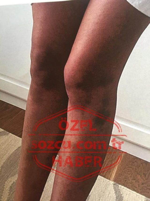 Ozan Güven'in dövdüğü Deniz Bulutsuz'un o geceye dair yeni fotoğrafları ortaya çıktı - Resim: 2