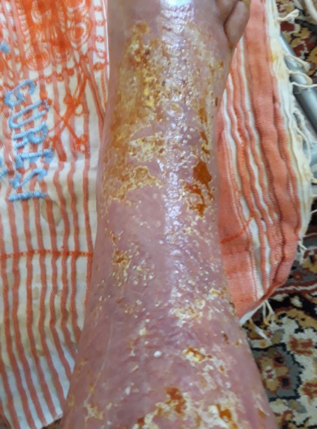 Yaralar içindeki bacağı kesilmek üzereydi! Bu yöntemle tamamen iyileşti - Resim: 4