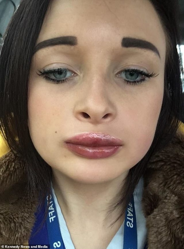 Dudak dolgusu konuşamaz hale getirdi! - Resim: 2