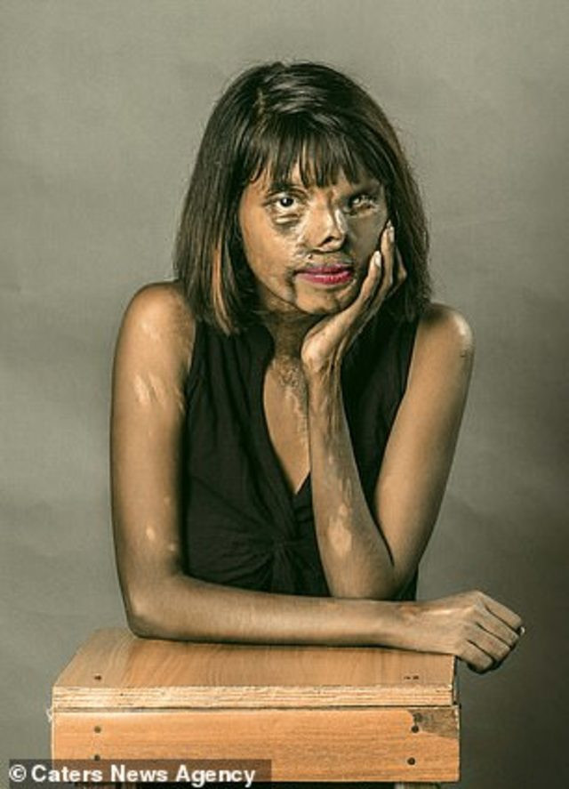 Annesi öldürüldü kendi asit saldırısına uğradı! Nedeni ise... - Resim: 3