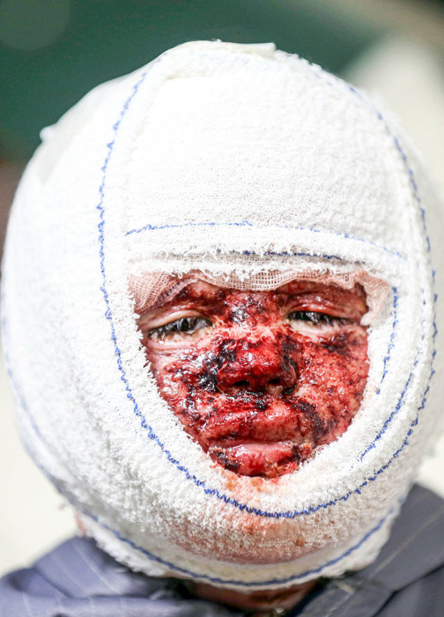 Yanıkların acısıyla kıvranan küçük çocuğun çığlıkları yürek burktu - Resim: 2